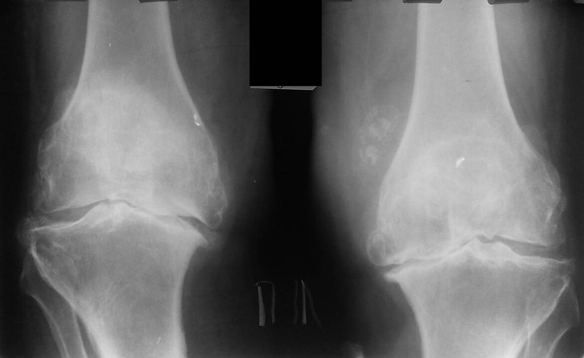x-ray of the knee joints with osteoarthritis