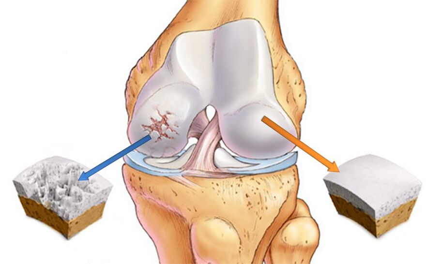 Arthrosis of the knee joint