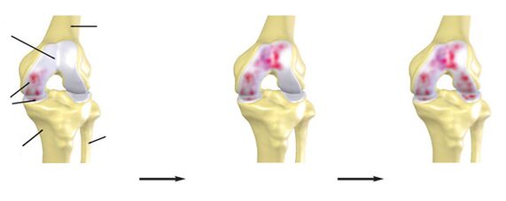 The degree of arthrosis of the knee joint