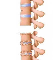 Phase of osteochondous ramps of the neck