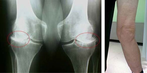 x-ray of osteoarthritis of the knee